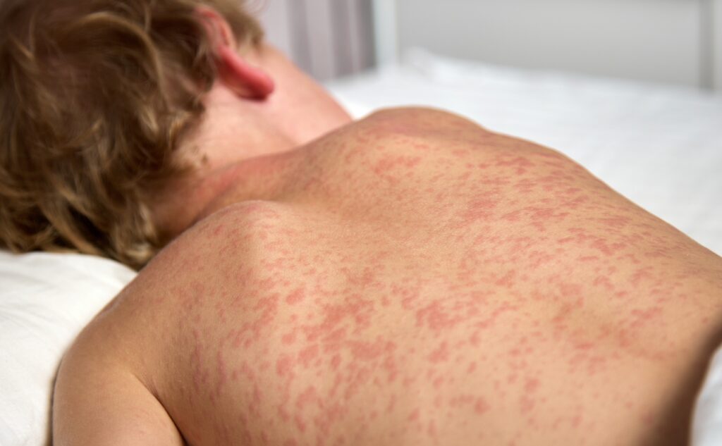 ALERTA EPIDEMIOLÓGICA: APARICIÓN DE SARAMPIÓN EN ARGENTINA